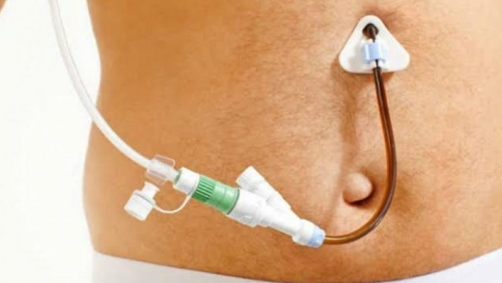 Como cuidar da gastrostomia?