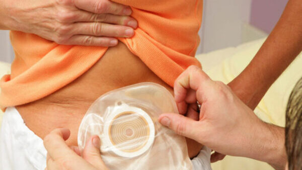 Estomaterapia: O Que É e Como Funciona