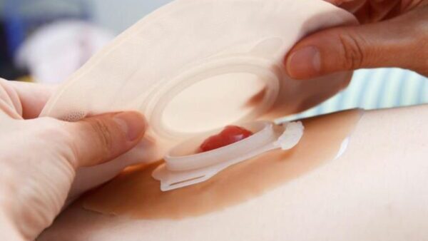 Vivendo bem com um estoma